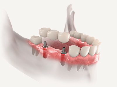 Dental Multiple Implants