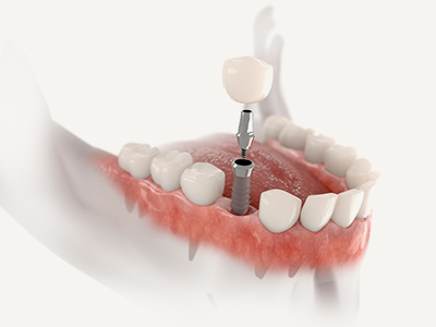 Dental Single Implants