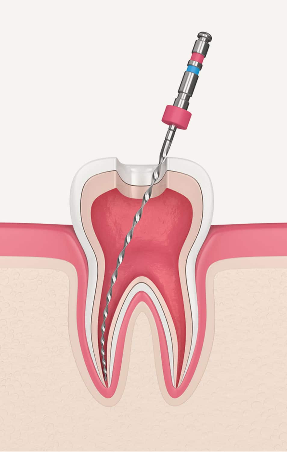 Root canal treatment