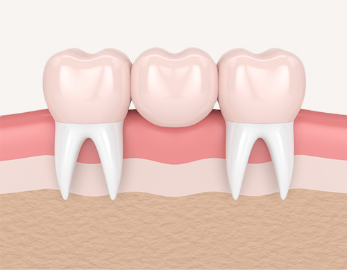 Type Dental Bridge