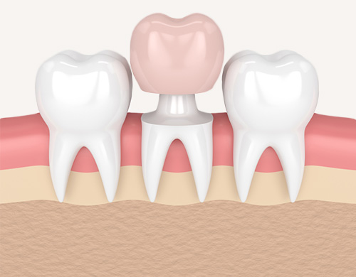 Type Dental Crown