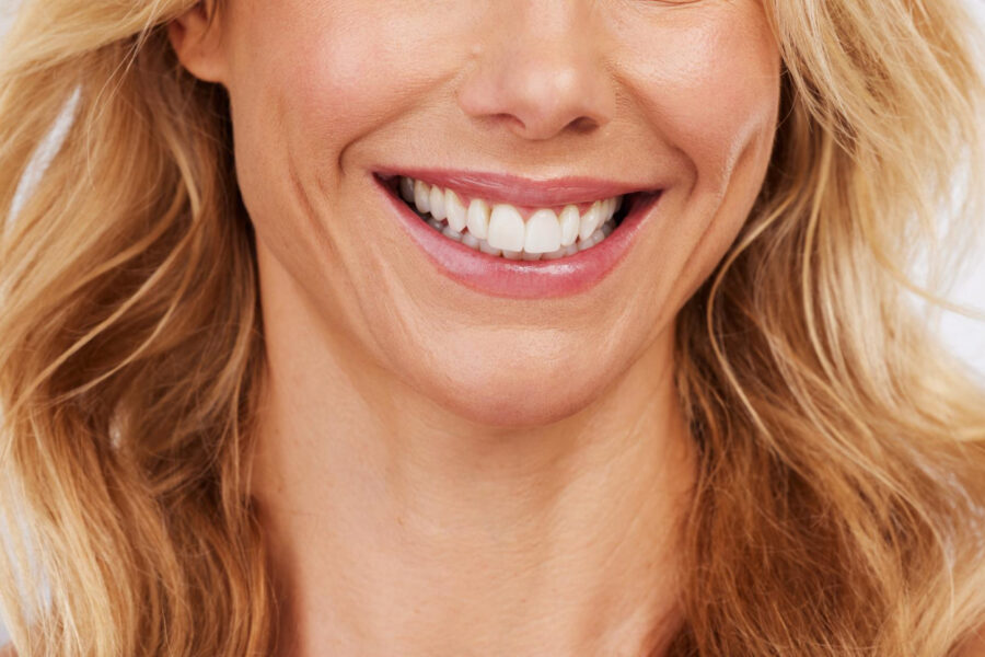 A close up of a woman's smile for a blog post on cosmetic bonding vs veneers