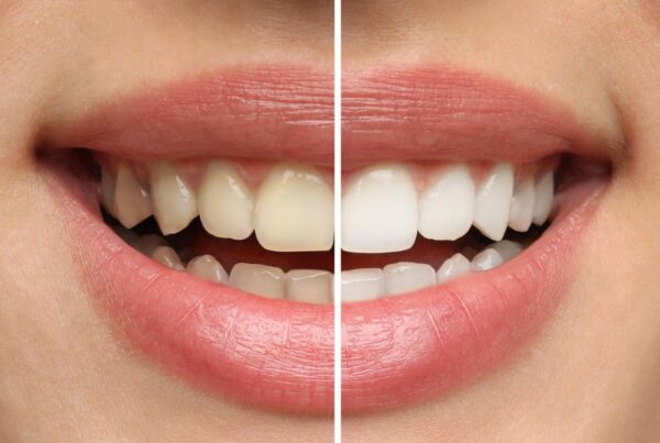 A before and after teeth whitening picture for a blog on the best way to whiten teeth