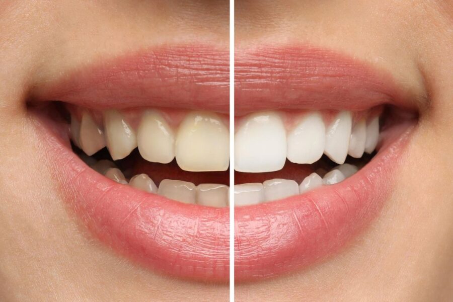A before and after teeth whitening picture for a blog on the best way to whiten teeth